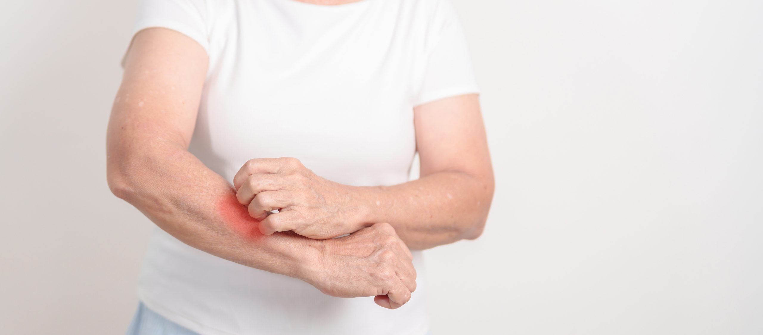 Henkilö pitelee ja raapii kyynärvarren aluetta, jossa on punoitusta; kuva viittaa punahukkaan (lupukseen) liittyviin iho-oireisiin.