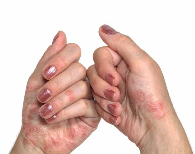 psoriasis