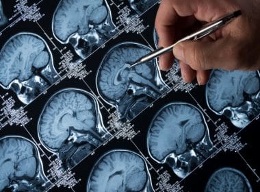 epilepsia
